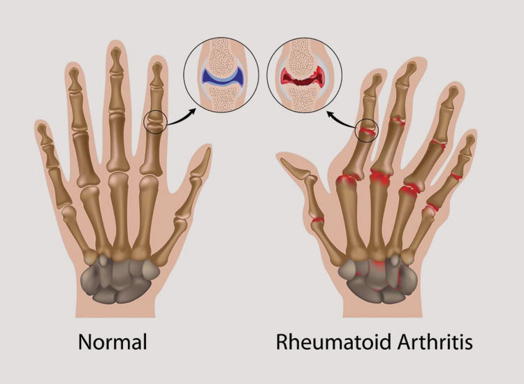 Rheumatoid Arthritis treatment 2019